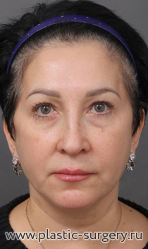 Open facelift, endoscopic lifting, upper and lower blepharoplasty
